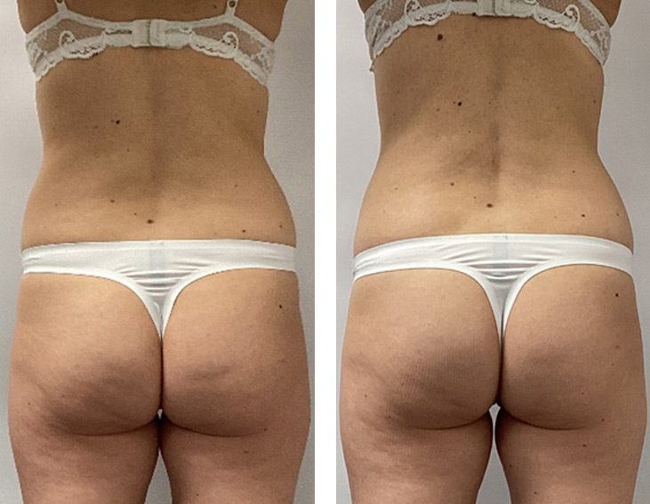 Plecy i talia od tyłu przed i po endermologii LPG Infinity – modelowanie sylwetki