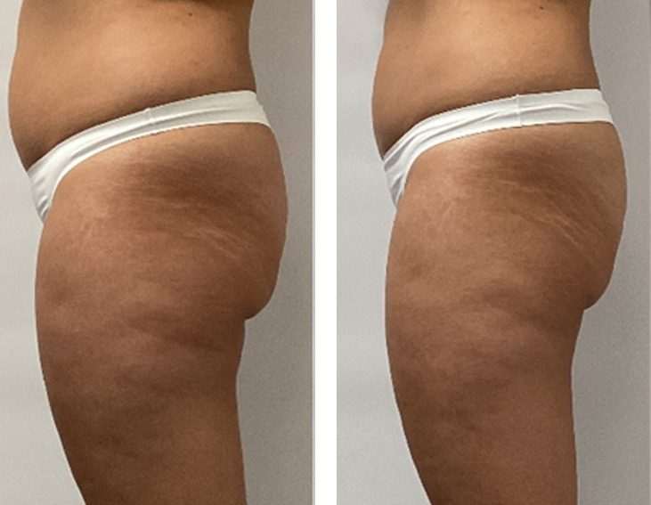 Uda i biodro z boku przed i po endermologii LPG Infinity – wygładzenie skóry