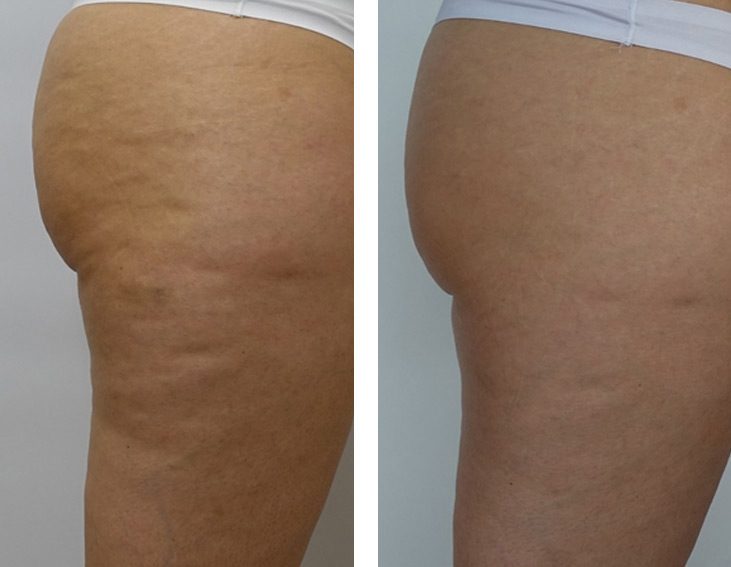 Presoterapia czy endermologia — co wybrać na nogi i drenaż | Estelium