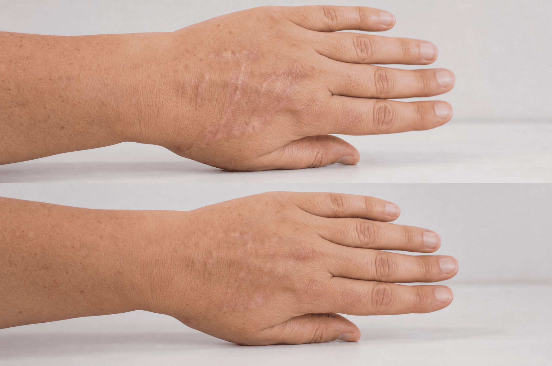 Blizna na dłoni – efekt przed i po serii zabiegów (klientka 1)